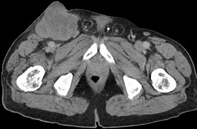 Case Report: Eighteen Month Relapse- Free Survival Following Radical Multidisciplinary Oncological Treatment in a 68-Year-Old Male Patient With Histiocytic Sarcoma